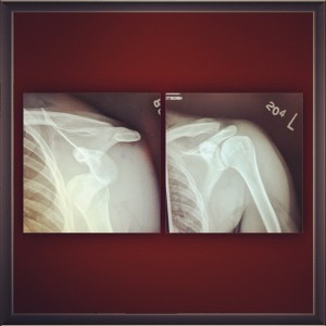 My Shoulder X-Ray: Left (dislocated), Right (relocated)